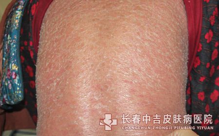 牛皮癣的症状图片是什么