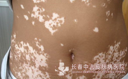 被误认白癜风的症状有哪些