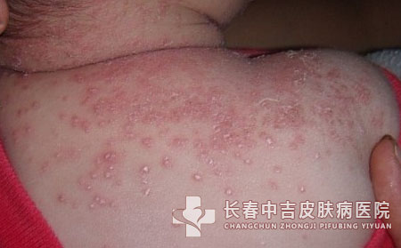 湿疹是怎么引发的