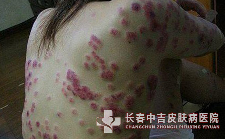 红斑狼疮长春哪里治疗效果合适