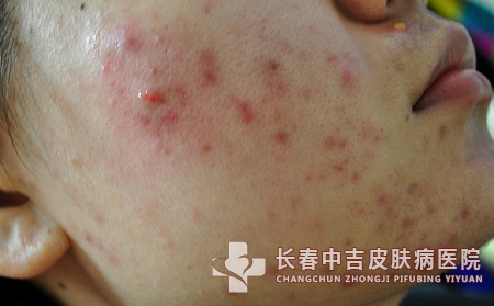 青春痘该怎么辨别