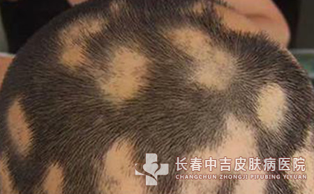 斑秃患者应该如何去预防疾病合适呢?