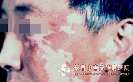 白癜风总是反复有办法治不错吗