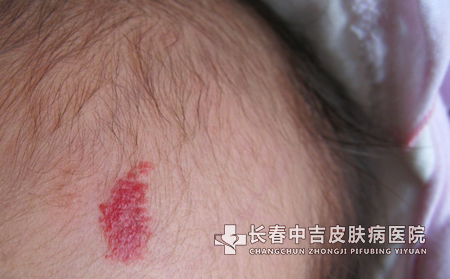 脸上有胎记要用什么方法治疗才见到效果