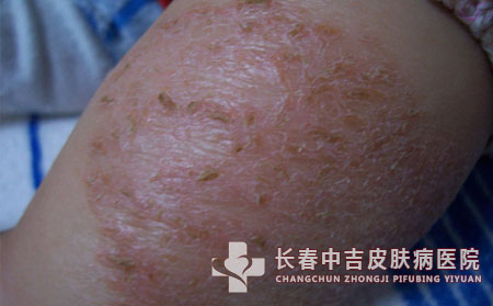湿疹应该去怎么治疗比较不错