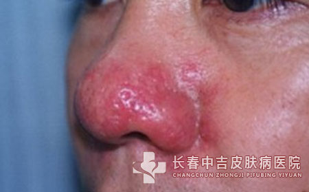 酒糟鼻的形成主要受哪些因素控制