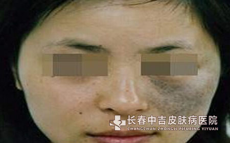 太田痣形成的原因有哪些？