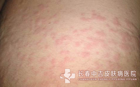 怎样能够有效的去治疗皮肤瘙痒敏感呢？