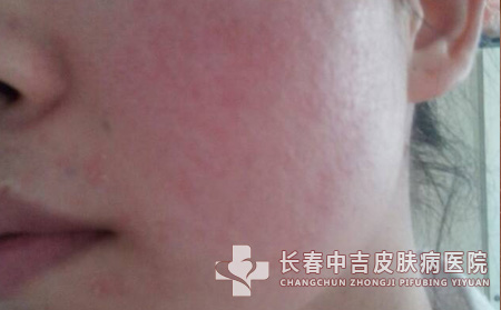 季节性皮肤瘙痒过敏要怎样进行护理呢？