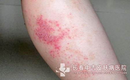 皮肤发生瘙痒过敏时有什么合适的应付方法吗?