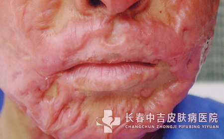 身上的瘢痕刚合适应该如何护理