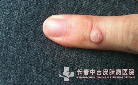 皮肤长扁平疣会出现什么症状呢？