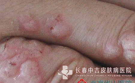 要怎样去除掉身上的扁平疣合适呢？