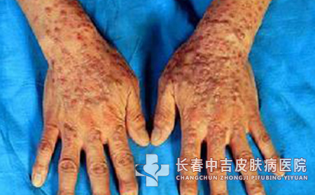 脸上的扁平疣该怎样去除比较不错呢？