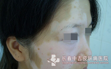 怎样做合适防止白癜风病情扩散呢？