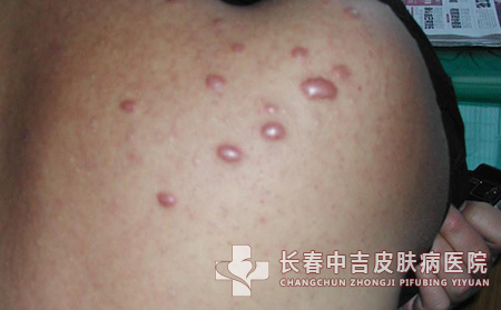 皮肤上有瘢痕疙瘩很痒怎样治疗呢？