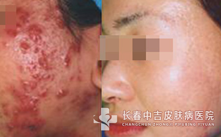 面部有痤疮应该怎样进行护理合适？