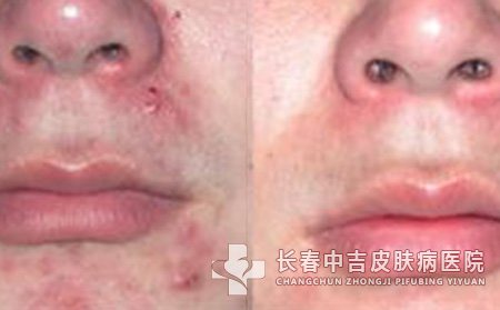 脸上的痤疮又复发了该怎么办呢？
