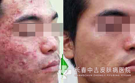 有痤疮用什么办法合适尽快消除呢？