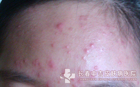 额头上总是起痤疮怎么办呢？