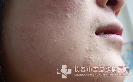 是什么原因长了扁平疣呢？
