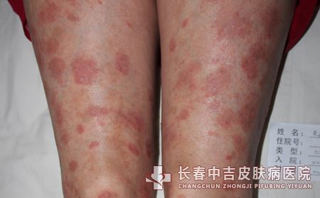 红皮型牛皮癣患者需要注意哪些饮食问题
