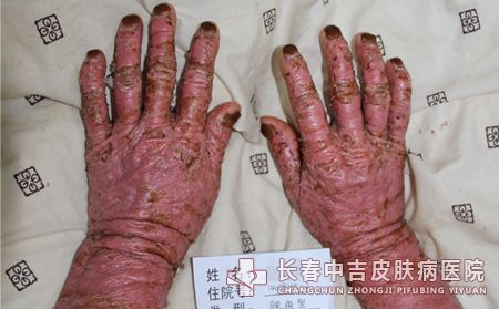 夏季牛皮癣患者调养的注意要点