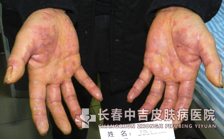 冬季牛皮癣患者怎么预防病发