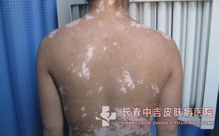 长春哪里有治疗点状型白癜风合适的医院