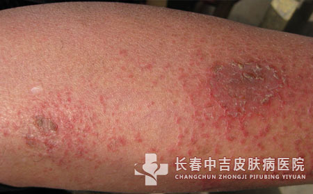 出现湿疹一般会有哪些原因造成如何治疗