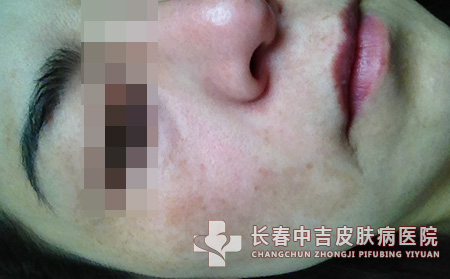 生活中常见的治疗黄褐斑的方法有哪些