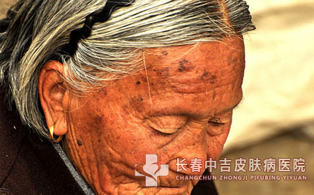 老年斑患者如何如何进行日常护理减轻病情