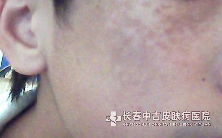 太田痣的常见发病人群主要有哪些