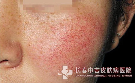 患者诱发红血丝的生活常因有哪些