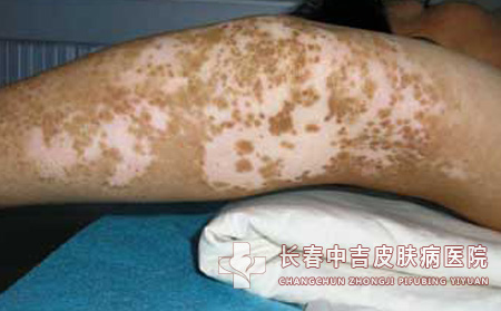 男性有白癜风要怎样治疗合适呢？