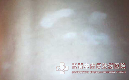 怎么预防白癜风带来的伤害