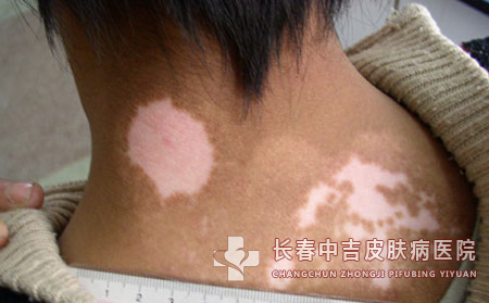 小儿得了白癜风要怎么办呢？
