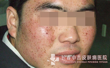 雀斑对我们有哪些危害和影响