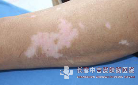 小孩得了白癜风要怎样进行治疗呢？