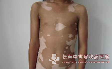 得上白癜风后要怎样治疗比较不错？