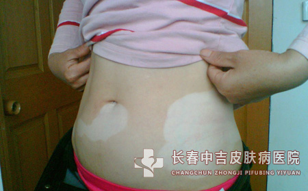 身上有白癜风怎么治不错？