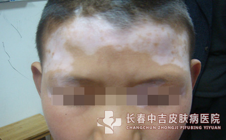 你了解白癜风有哪些症状表现
