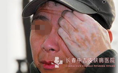 那些内外原因会使白癜风病情加重