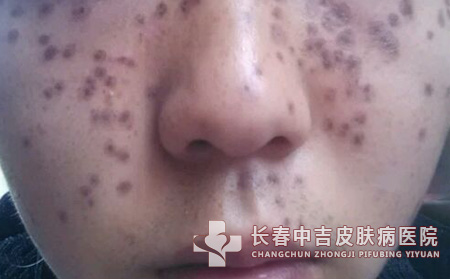 青少年得了雀斑怎么样去进行治疗