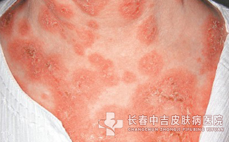 红斑狼疮的治疗误区有哪些