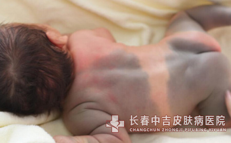 为什么刚出生的宝宝身上会长胎记