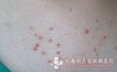 治疗扁平疣有哪些原则要注意