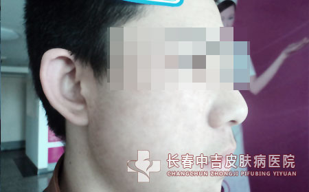 手部雀斑患者在夏天要注意些什么