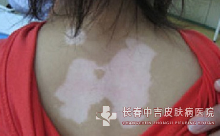 为什么小孩子手上长白癜风