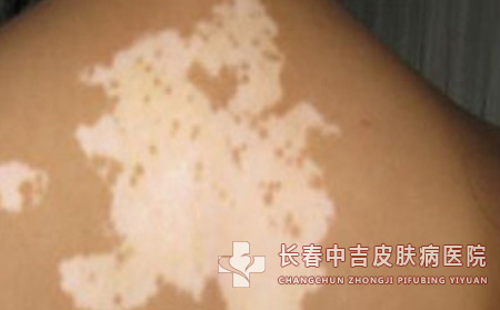 孩子手上长了白癜风怎么办